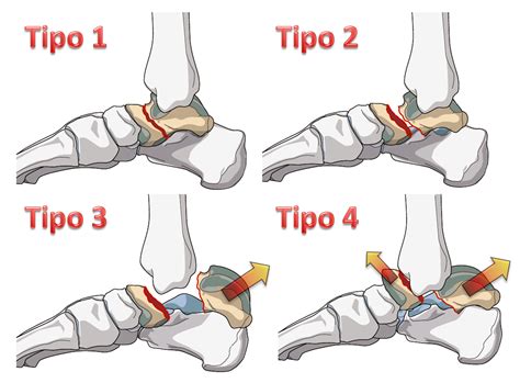 Clínica E Cirurgia Do Pé E Tornozelo Fraturas Do Tálus