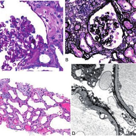 Light Microscopy A C And Electron Microscopy D Pictures Of A Renal