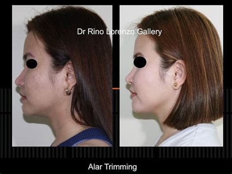 The Renewed You - Face Lift Philippines - Some Benefits of Having a Facial Surgery Procedure