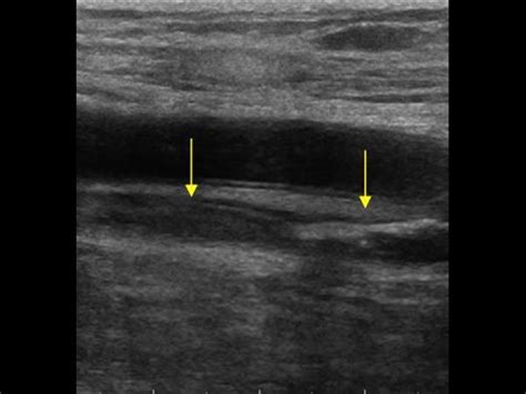 Peripheral vessels | 10.2 Peripheral veins : Case 10.2.3 Recanalized deep venous thrombosis ...