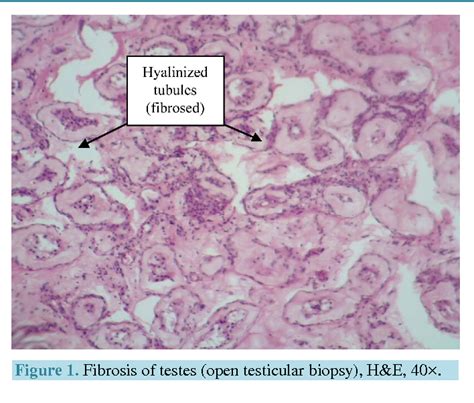 Figure From Testicular Fine Needle Aspiration Cytology Versus Open