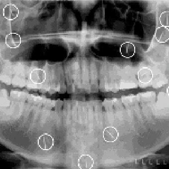 Intra Oral Peri Apical Radiograph Showing Charm Needle Over The Root Of