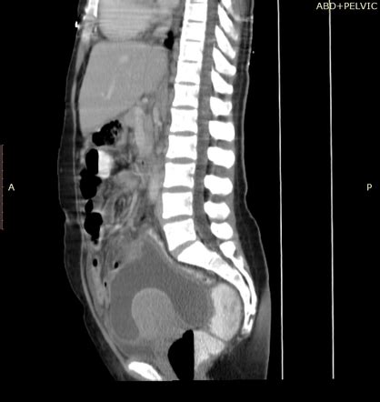 Appendicular Abscess Radiology Reference Article Radiopaedia Org