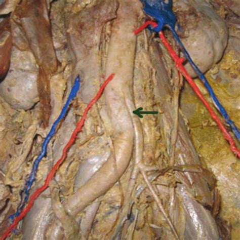 Pdf Three Rare Variations In The Course Of The Gonadal Artery