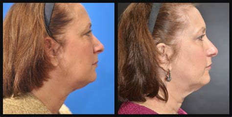 CoolSculpting of Neck - Dr. Dean Kane Center for Cosmetic Surgery & MediSpa