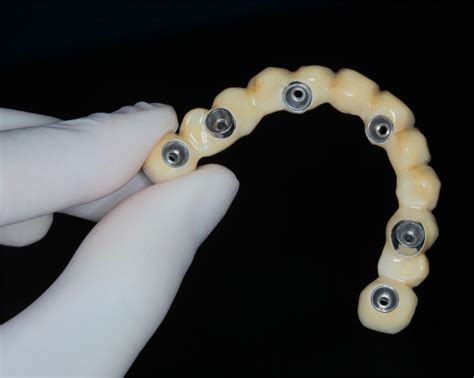 All On Zirconia Bridges Orange Ca Dr Christopher J Fotinos