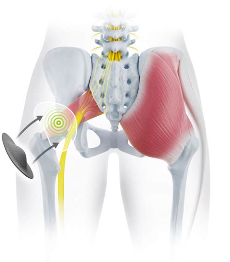 Piriformis Syndrome Bort