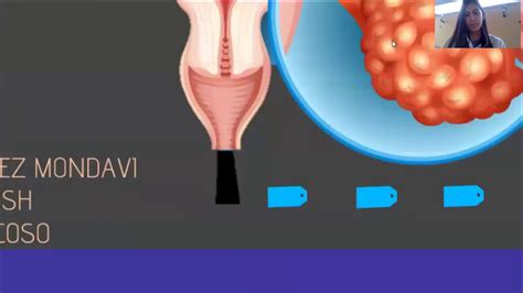 Secondary surgical cytoreduction for recurrent ovarian cancer - YouTube