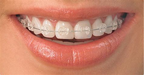 Clear Braces Clarendon Dental Spa Leeds