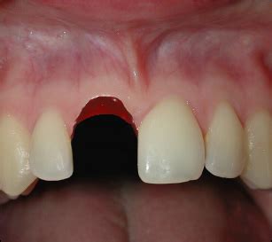 Avulsion | Pocket Dentistry