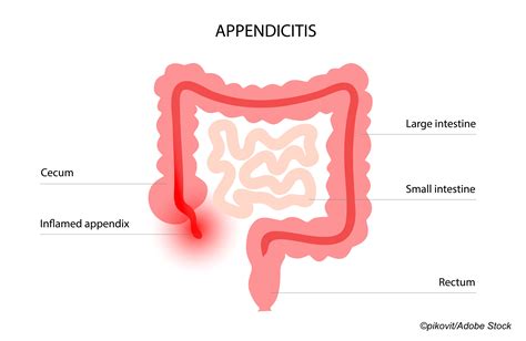 Acute Appendicitis Looking At Treatment Options Beyond Surgery