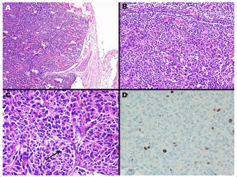 A Photomicrograph Showing A Relatively Well Circumscribed Tumor With