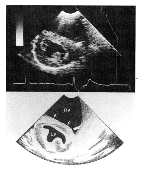 Right Ventricular Infarction Nejm