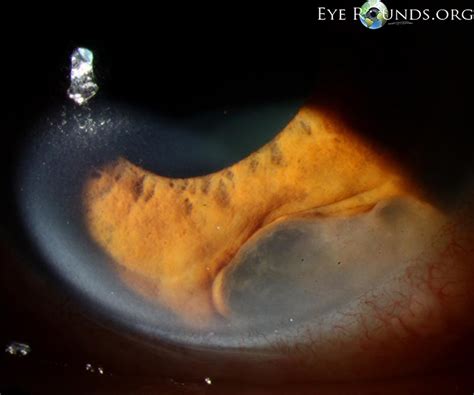 Atlas Entry - Anterior chamber epithelial inclusion cyst