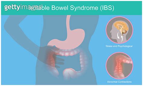 Irritable Bowel Syndrome Illustration Explain Abnormal Contractions And Pain Perception Human