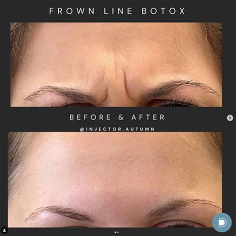 Med Spa And Dermatologist Hendersonville Nc Dermablue