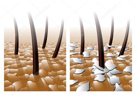 Dandruff Hair Problem — Stock Vector © Rob3000 65090195