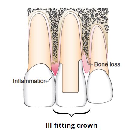 Is it Time to Replace Your Dental Crown? A Comprehensive Guide