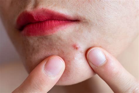 Acne Nodules On Face