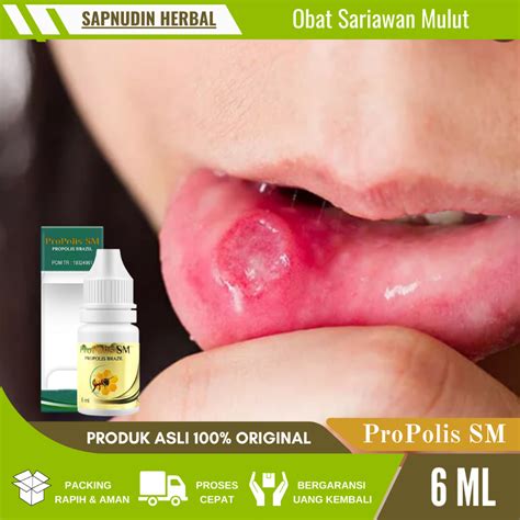 Jual Obat Sariawan Mulut Obat Sariawan Anak Obat Sariawan Di Bibir