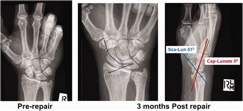 Scapholunate Dissociation