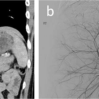 AAST grade III liver laceration (a) in segment 7 with possible... | Download Scientific Diagram