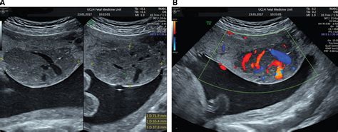 Large Placental Chorioangioma A Potential Effective In Utero Treatment