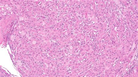 Mucoepidermoid Carcinoma Comprising A Large Epidermoid Cells Download Scientific Diagram