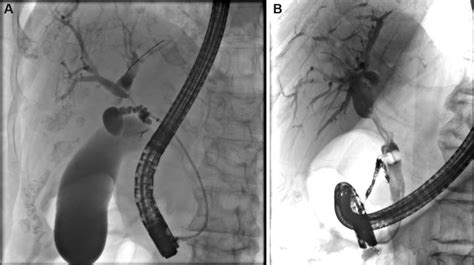 Endoscopic Retrograde Pancreatography Image Demonstrating A Hilar