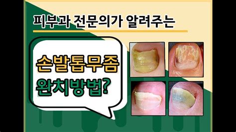 발톱무좀 경향과 치료법 만나보기 Thép Phú Châu