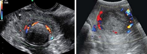 Doppler Ultrasound Of Uterine Fibroid Lesions Showing Perilessal Download Scientific Diagram