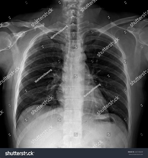 Film Xray Right Claviclecollarbone Show Fracture Stock Photo 242146639