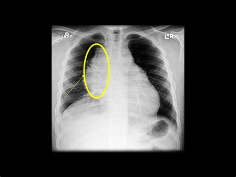 Primary mediastinal large B-cell lymphoma x ray - wikidoc