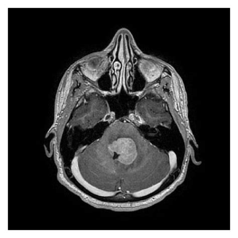 T Weighted Gadolinium Enhanced Axial Magnetic Resonance Image