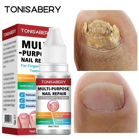 Nail Fungal Treatment Feet Care Essence Anti Infection Paronychia