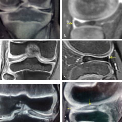 MRI and Arthroscopic images; discoid meniscus of the right knee ...