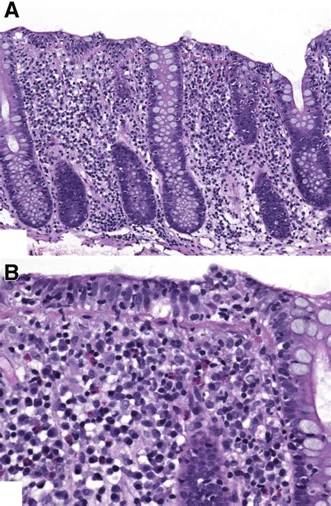 Microscopic Colitis Clinical And Pathologic Perspectives Clinical Gastroenterology And Hepatology