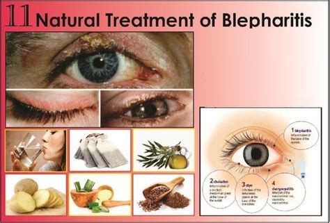 11 Best Natural Treatments Of Blepharitis Blepharitis Blepharitis