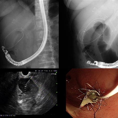 Consecutive Steps Of Endoscopic Ultrasound Eus Guided Transmural