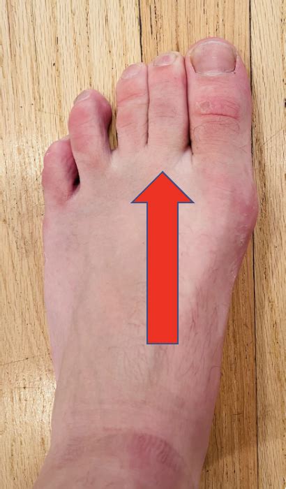 Second Toe Pain When Walking