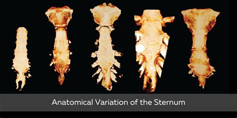 The Importance Of Anatomical Variations With Bodyviz D Anatomy