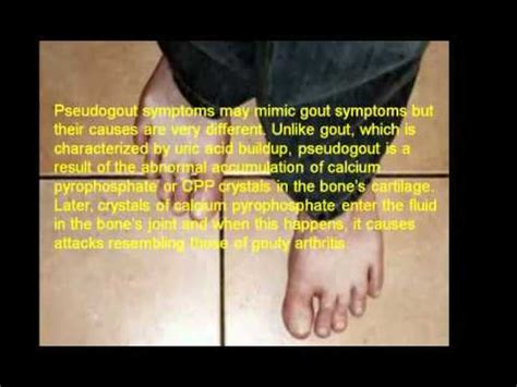 What Are Pseudogout Symptoms? Pseudogout Treatment - YouTube