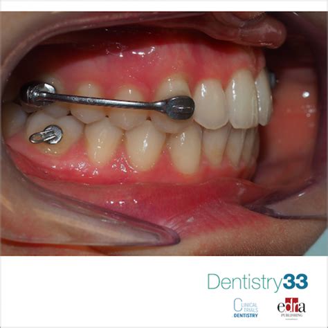 Comparison Of Shorty And Standard Class Ii Carriere Motion Appliance Dentistry33