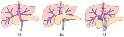 Positional Relationship Between Bypass Vessel Routes And The Pancreas