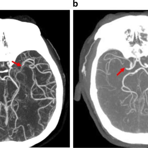 Middle Cerebral Artery Occlusion And Collateral Circulation Computed