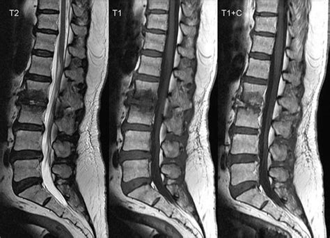 💊 Discitis Causas Síntomas Y Diagnóstico 2021