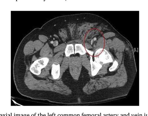 Figure 1 From Traumatic Femoral Arteriovenous Fistula Following Gunshot