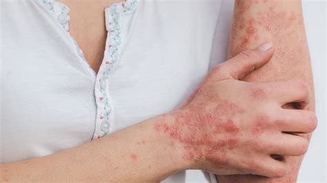 Tratamiento Para La Psoriasis En C Cuta Dra Juliana C Ceres