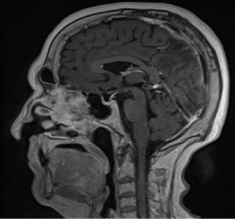 Sagittal T1 Weighted Magnetic Resonance Imaging Cranial Scan Shows