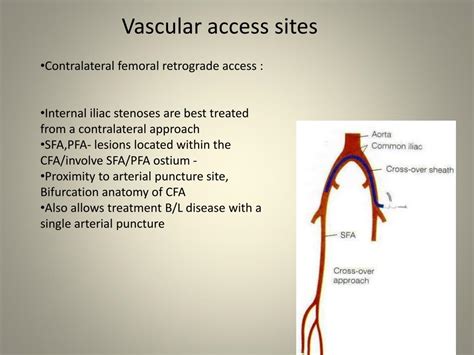 Ppt Peripheral Angioplasty Overview Hardware Powerpoint Presentation